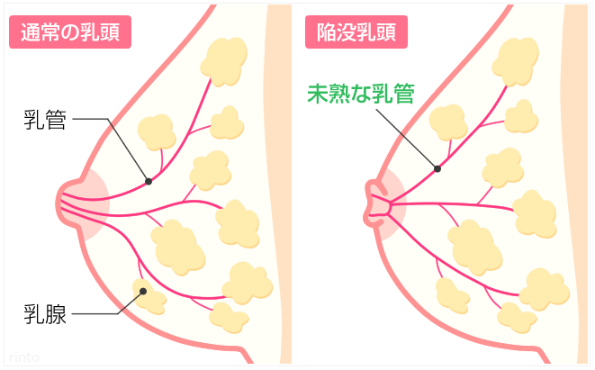 乳輪が大きい人の原因7選!小さくする方法 ...